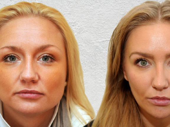 bruksizm leczenie botoks dr Marusza, Warszawa